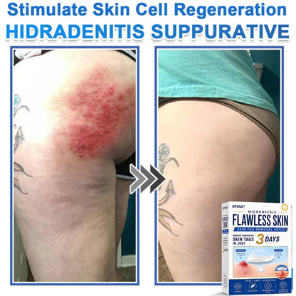 🆕GFOUK® 2026 Newly Upgraded 2-in-1 Microneedle Hydrocolloid Patches | Removes Raised Moles, Acne, Flat Warts, and Skin Tags | Improves Wrinkles, Scars, and Blemishes | Invisible Acne Patches for Face & Body