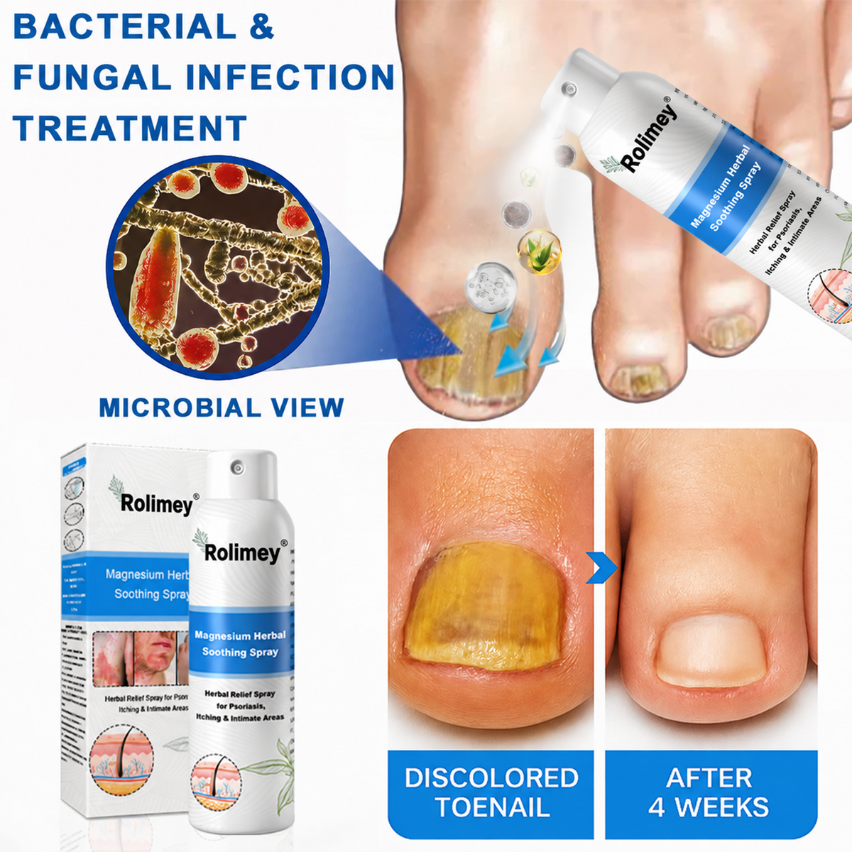 💯Official Store: Rolimey®Magnesium Herbal Psoriasis Spray⚕️Health Canada Certified (Relief for Psoriasis and Eczema, Improvement of Bacterial Infections in the Genital Area, Elieves joint pain and neuropathic pain) (Copy)