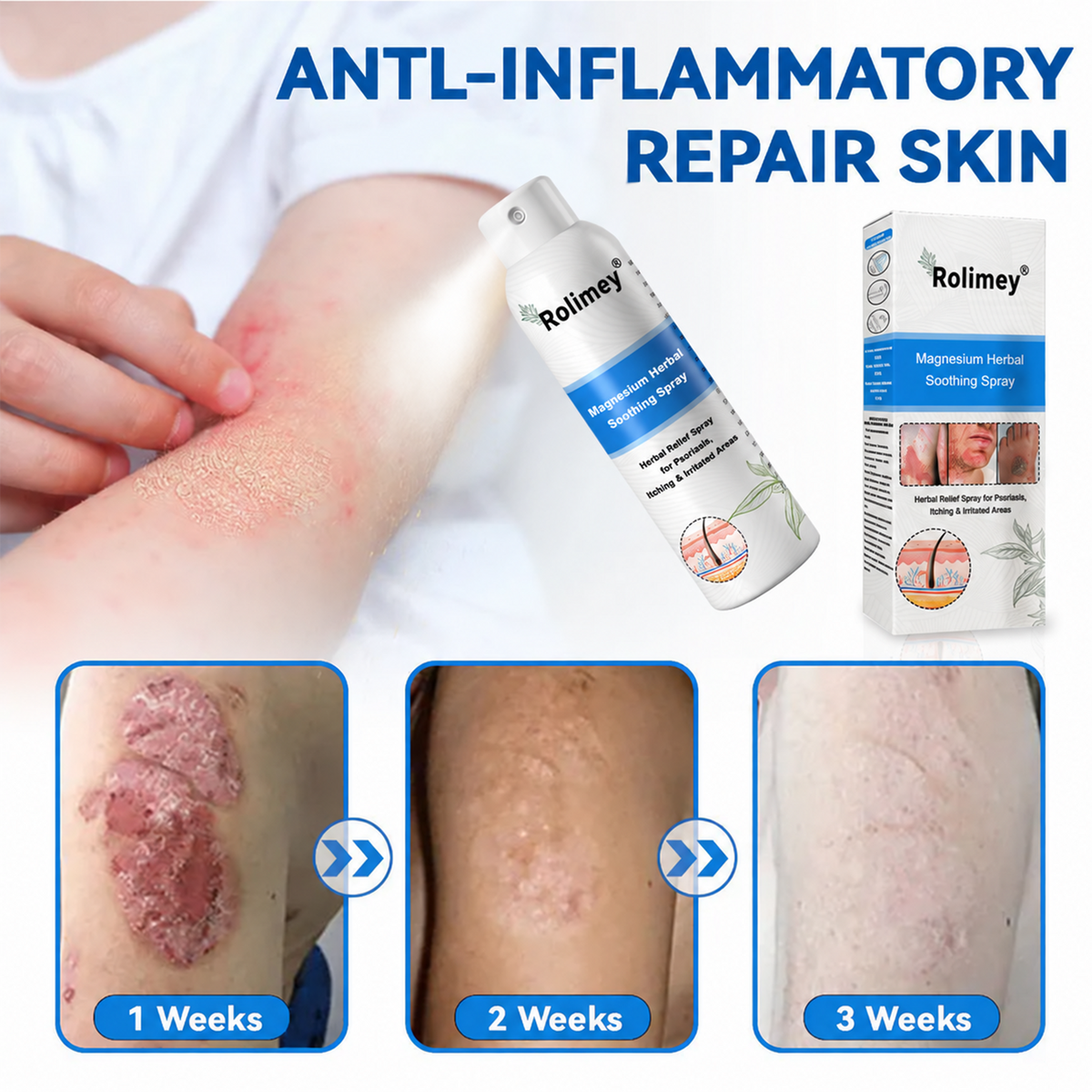 💯Official Store: Rolimey®Magnesium Herbal Psoriasis Spray⚕️Health Canada Certified (Relief for Psoriasis and Eczema, Improvement of Bacterial Infections in the Genital Area, Elieves joint pain and neuropathic pain) (Copy)
