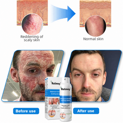 💯Official Store: Rolimey®Magnesium Herbal Psoriasis Spray⚕️Health Canada Certified (Relief for Psoriasis and Eczema, Improvement of Bacterial Infections in the Genital Area, Elieves joint pain and neuropathic pain) (Copy)