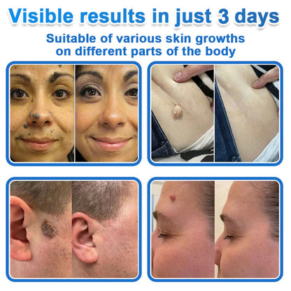 🆕GFOUK® 2026 Newly Upgraded 2-in-1 Microneedle Hydrocolloid Patches | Removes Raised Moles, Acne, Flat Warts, and Skin Tags | Improves Wrinkles, Scars, and Blemishes | Invisible Acne Patches for Face & Body