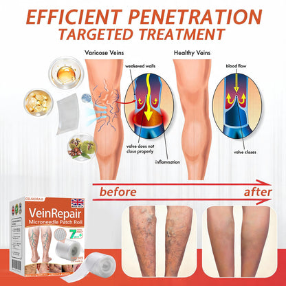 🧑‍⚕️🔥Celsiora® Vein Ease Microneedle Care Patch(For Spider Veins, Varicose Veins, Swelling & Leg Fatigue)