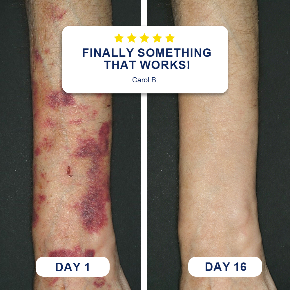 🗽Evolvion® Bruise Repair & Skin-Strengthening Cream
