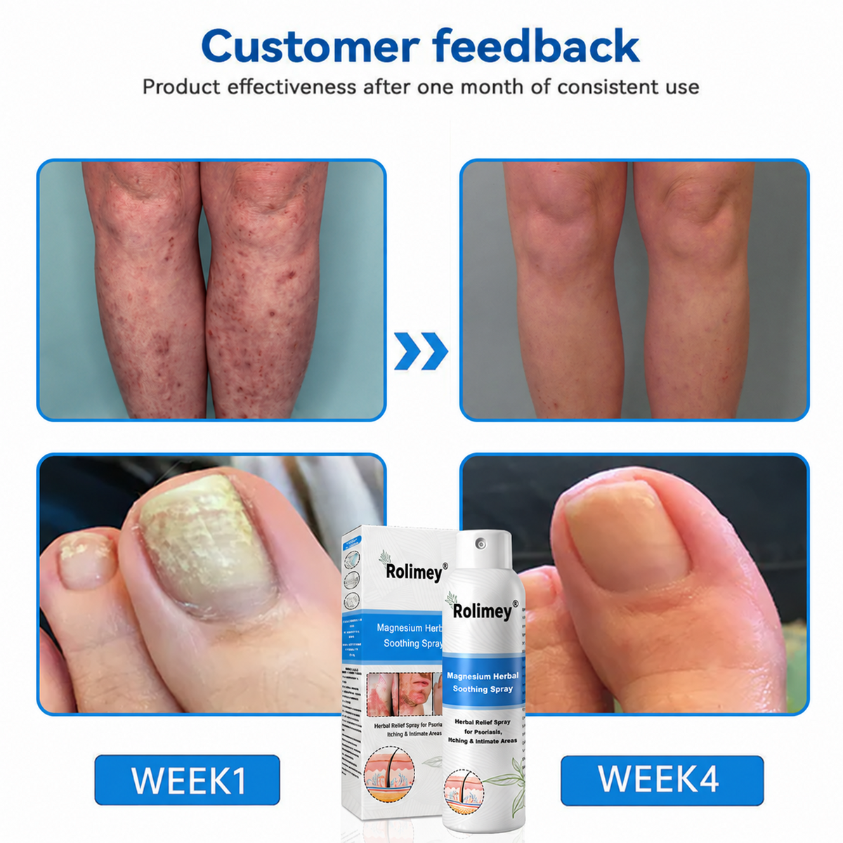 💯Official Store: Rolimey®Magnesium Herbal Psoriasis Spray⚕️Health Canada Certified (Relief for Psoriasis and Eczema, Improvement of Bacterial Infections in the Genital Area, Elieves joint pain and neuropathic pain) (Copy)