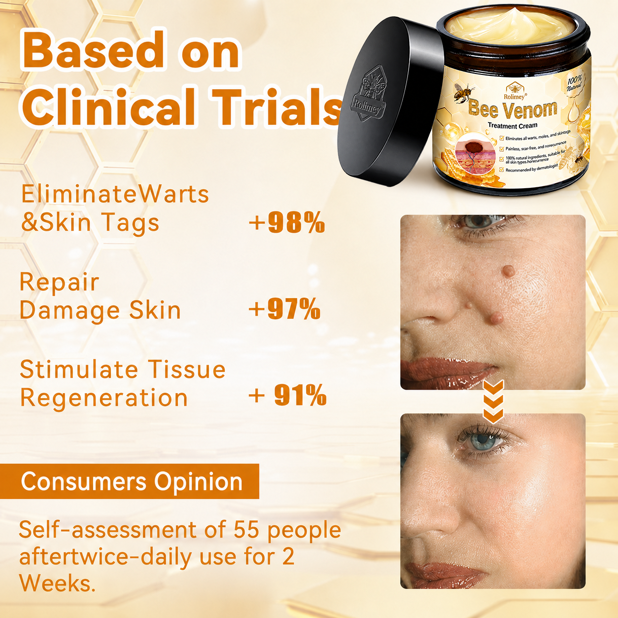 🔥Rolimey™ Bee Venom Skin Treatment Cream British Association of Dermatologists (BAD) Approved(Helping with acne, wart, rosacea, psoriasis, age spots, eczema, and reducing the appearance of stretch marks)🏵️