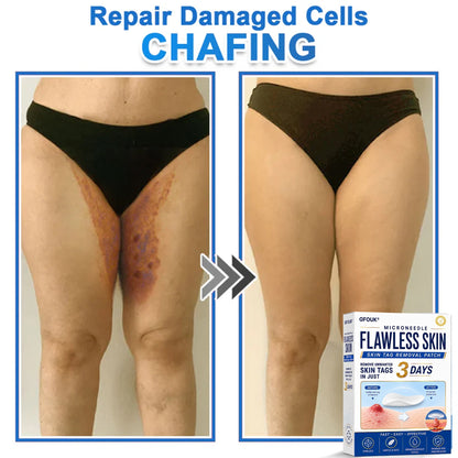 🆕GFOUK® 2026 Newly Upgraded 2-in-1 Microneedle Hydrocolloid Patches | Removes Raised Moles, Acne, Flat Warts, and Skin Tags | Improves Wrinkles, Scars, and Blemishes | Invisible Acne Patches for Face & Body
