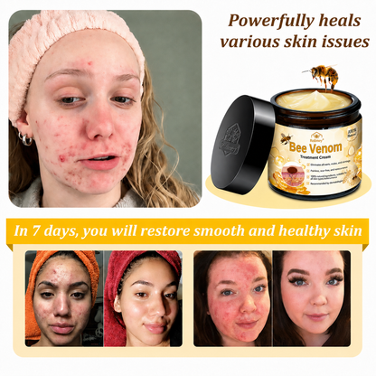 🔥Rolimey™ Bee Venom Skin Treatment Cream British Association of Dermatologists (BAD) Approved(Helping with acne, wart, rosacea, psoriasis, age spots, eczema, and reducing the appearance of stretch marks)🏵️