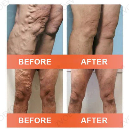 🧑‍⚕️🔥Celsiora® Vein Ease Microneedle Care Patch(For Spider Veins, Varicose Veins, Swelling & Leg Fatigue)