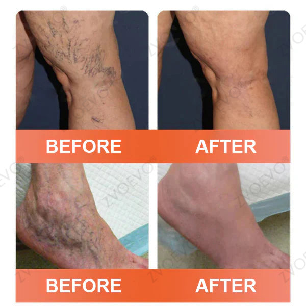 🧑‍⚕️🔥Celsiora® Vein Ease Microneedle Care Patch(For Spider Veins, Varicose Veins, Swelling & Leg Fatigue)