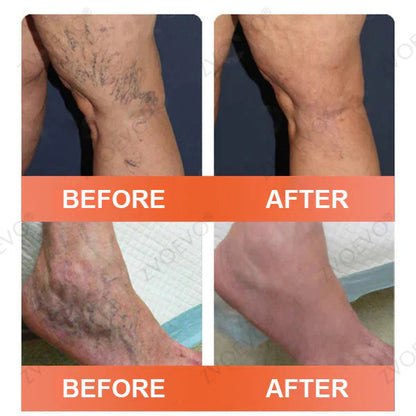 🧑‍⚕️🔥Celsiora® Vein Ease Microneedle Care Patch(For Spider Veins, Varicose Veins, Swelling & Leg Fatigue)