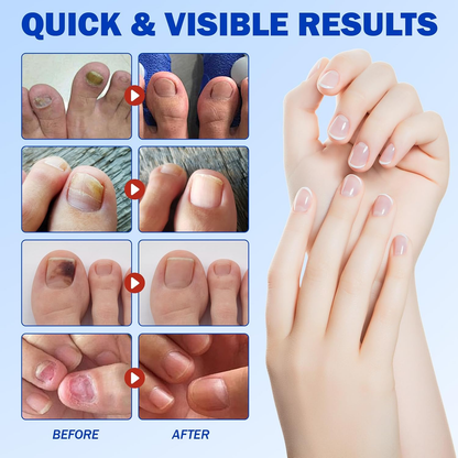 🔥Buy 1 Get 1  Free🔥21 Count/bag Nail Health Care Patches,Toenail Fungus Treatment Extra Strength