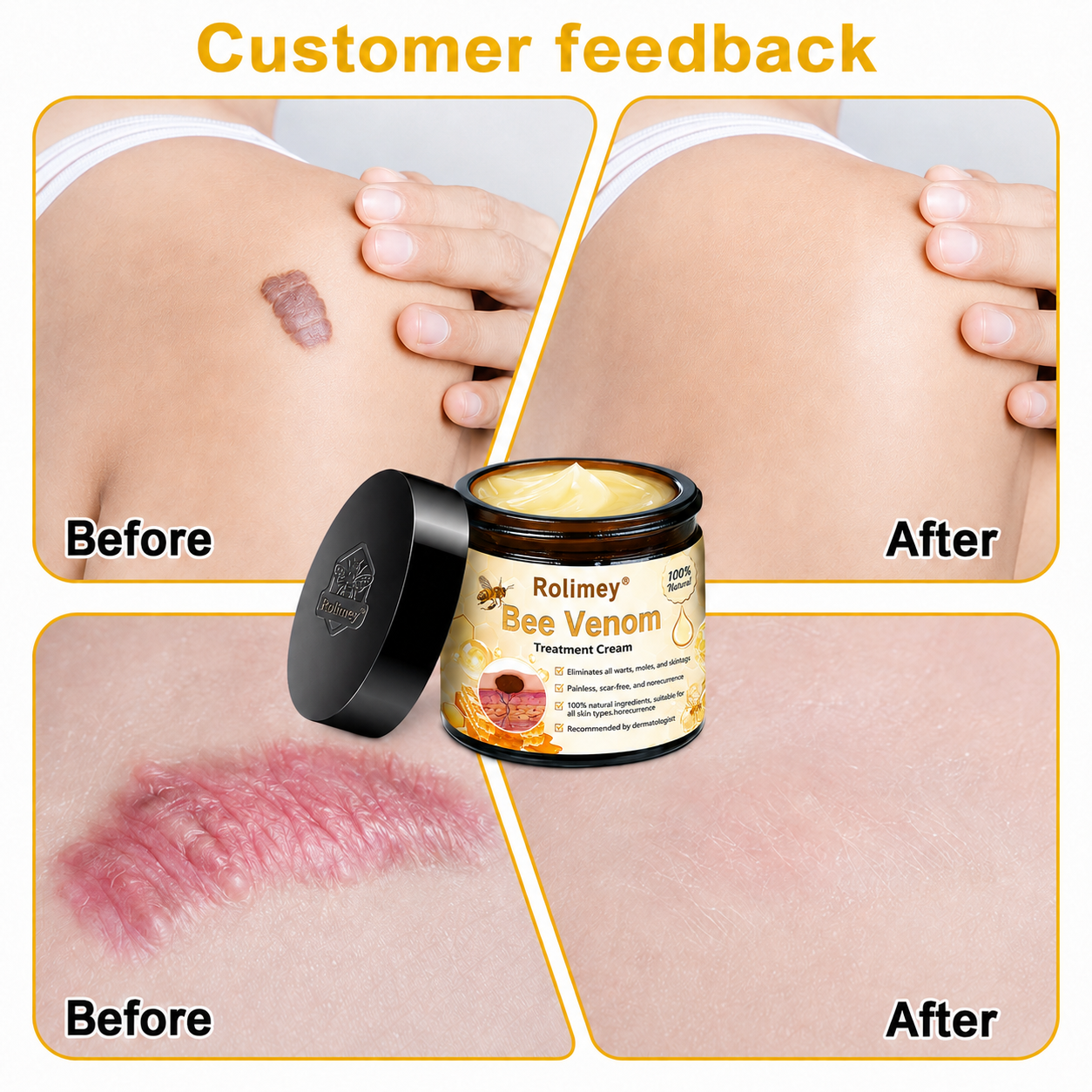 🔥Rolimey™ Bee Venom Skin Treatment Cream British Association of Dermatologists (BAD) Approved(Helping with acne, wart, rosacea, psoriasis, age spots, eczema, and reducing the appearance of stretch marks)🏵️