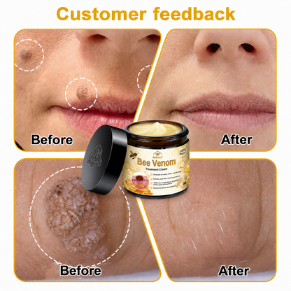 🔥Rolimey™ Bee Venom Skin Treatment Cream British Association of Dermatologists (BAD) Approved(Helping with acne, wart, rosacea, psoriasis, age spots, eczema, and reducing the appearance of stretch marks)🏵️