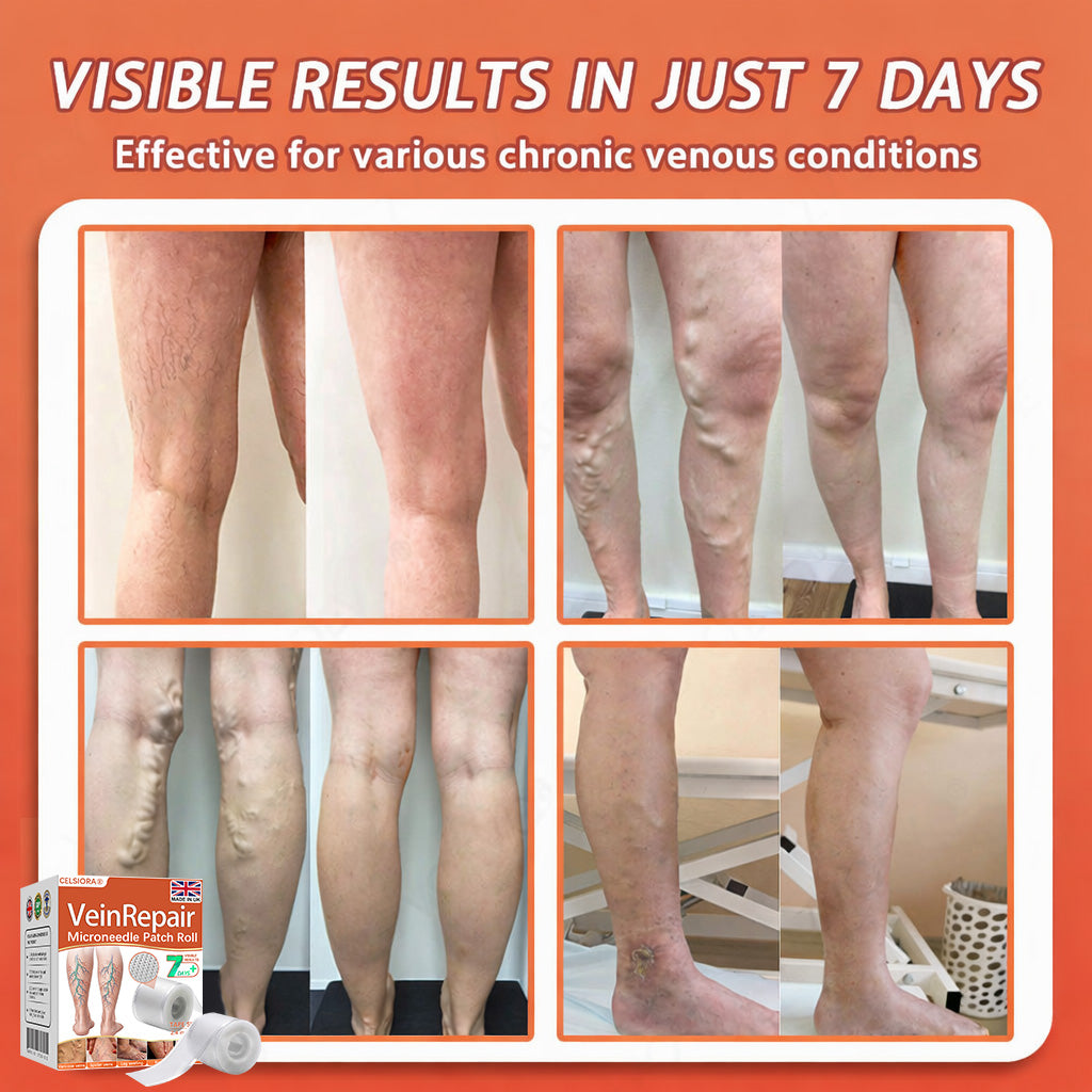 🧑‍⚕️🔥Celsiora® Vein Ease Microneedle Care Patch(For Spider Veins, Varicose Veins, Swelling & Leg Fatigue)