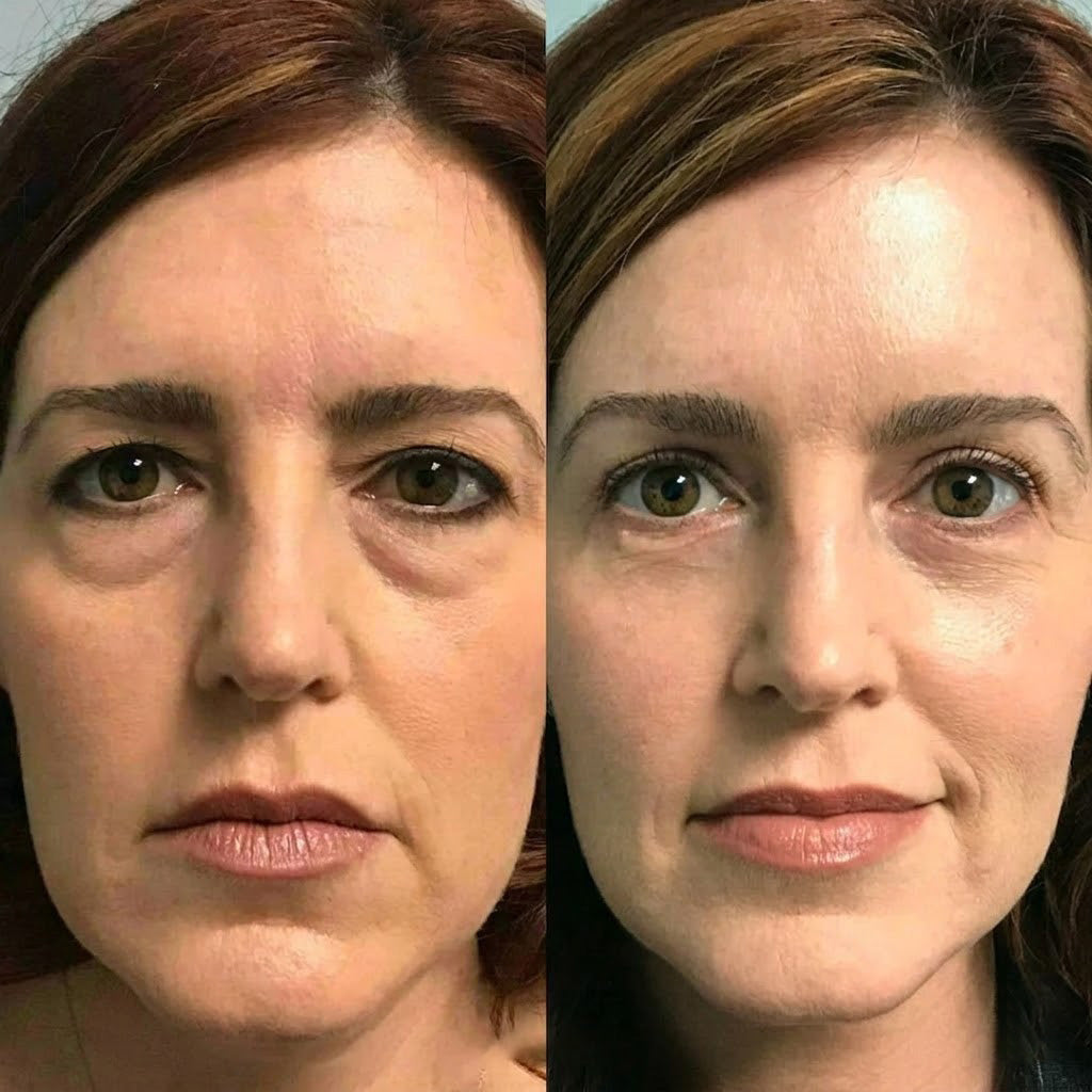 Rolimey®Wrinkle-Lift Tightening cream